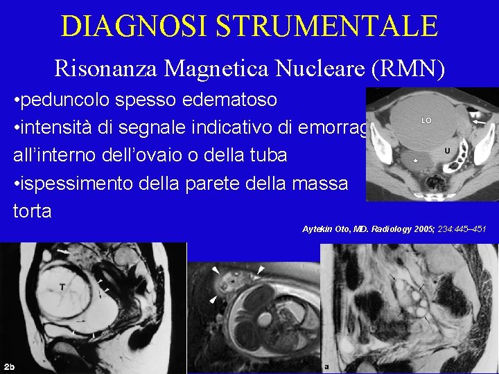 DIAGNOSI STRUMENTALE Risonanza Magnetica Nucleare (RMN) • peduncolo spesso edematoso • intensità di segnale
