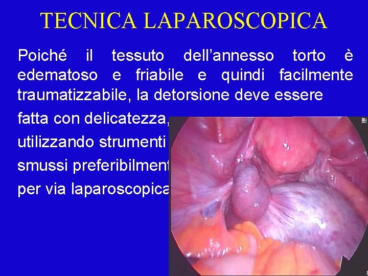 TECNICA LAPAROSCOPICA Poiché il tessuto dell’annesso torto è edematoso e friabile e quindi facilmente