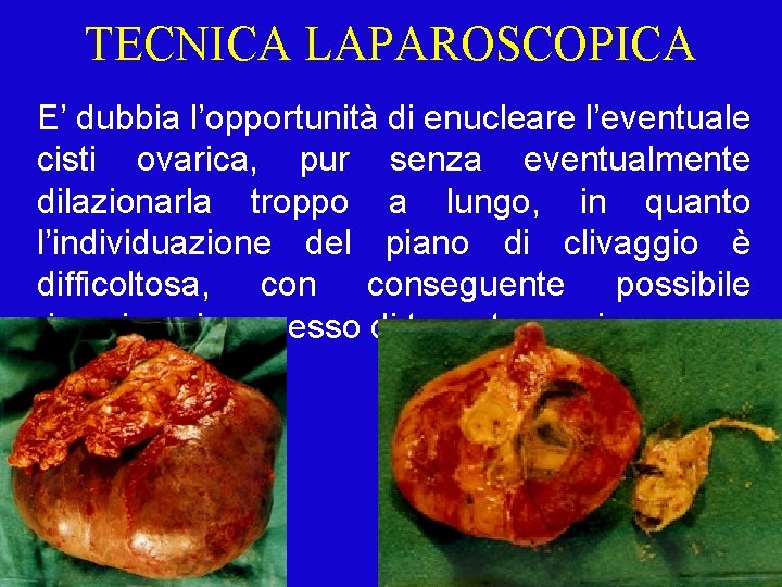 TECNICA LAPAROSCOPICA E’ dubbia l’opportunità di enucleare l’eventuale cisti ovarica, pur senza eventualmente dilazionarla