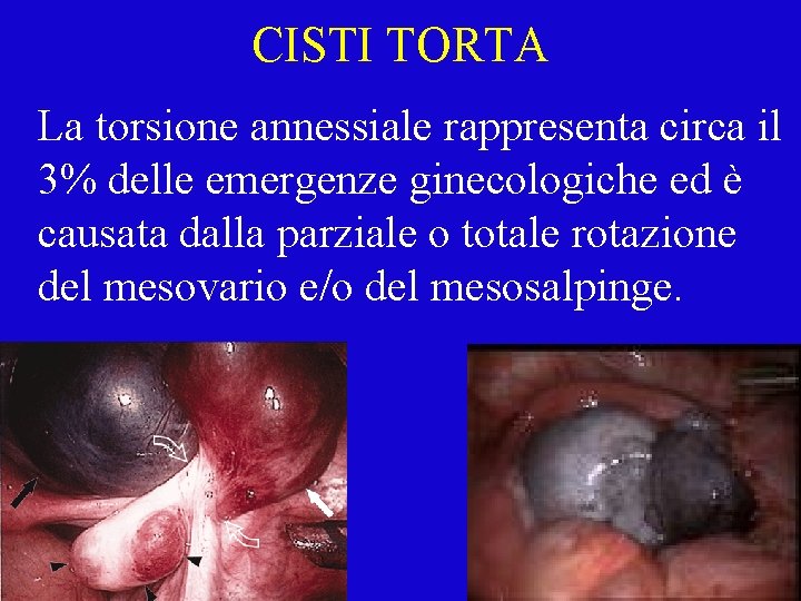 CISTI TORTA La torsione annessiale rappresenta circa il 3% delle emergenze ginecologiche ed è