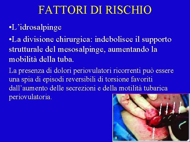 FATTORI DI RISCHIO • L’idrosalpinge • La divisione chirurgica: indebolisce il supporto strutturale del