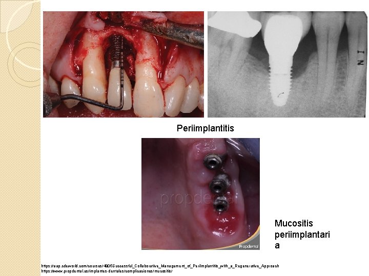 Periimplantitis Mucositis periimplantari a https: //aap. cdeworld. com/courses/4805 Successful_Collaborative_Management_of_Peri. Implantitis_with_a_Regenerative_Approach https: //www. propdental. es/implantes-dentales/complicaciones/mucositis/