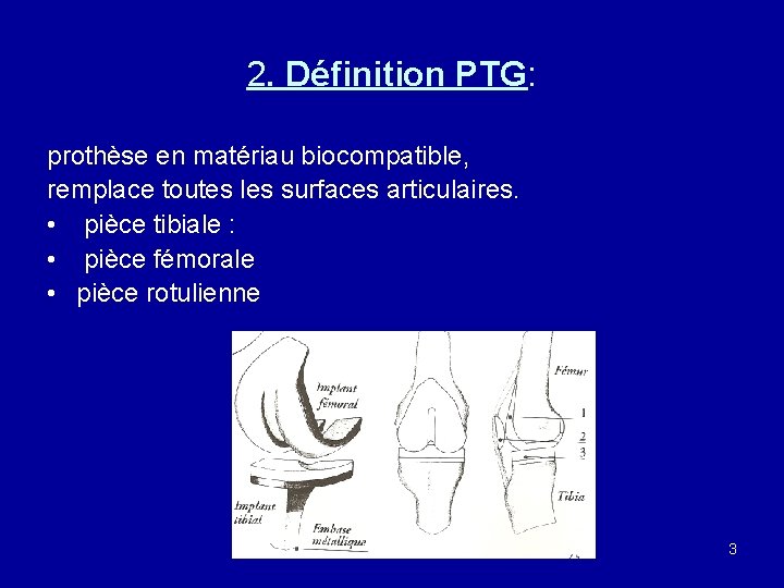 2. Définition PTG: prothèse en matériau biocompatible, remplace toutes les surfaces articulaires. • pièce