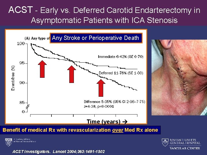 ACST - Early vs. Deferred Carotid Endarterectomy in Asymptomatic Patients with ICA Stenosis Any