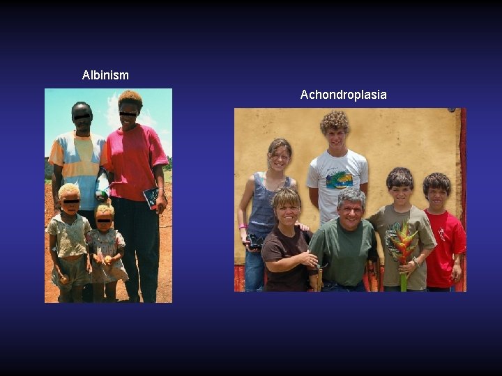 Albinism Achondroplasia 