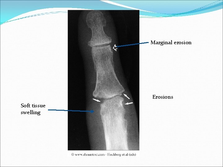 Marginal erosion Erosions Soft tissue swelling 