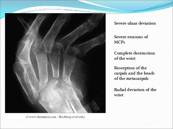 Severe ulnar deviation Severe erosions of MCPs Complete destruction of the wrist Resorption of