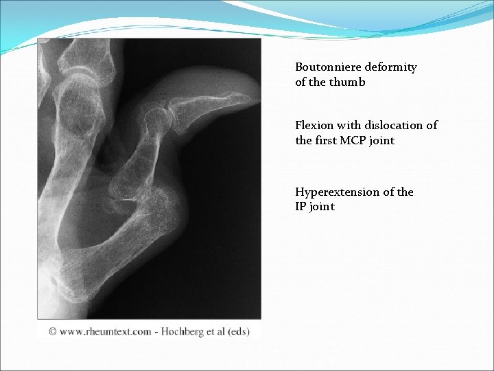 Boutonniere deformity of the thumb Flexion with dislocation of the first MCP joint Hyperextension