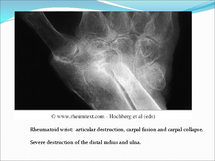 Rheumatoid wrist: articular destruction, carpal fusion and carpal collapse. Severe destruction of the distal