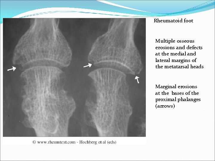 Rheumatoid foot Multiple osseous erosions and defects at the medial and lateral margins of