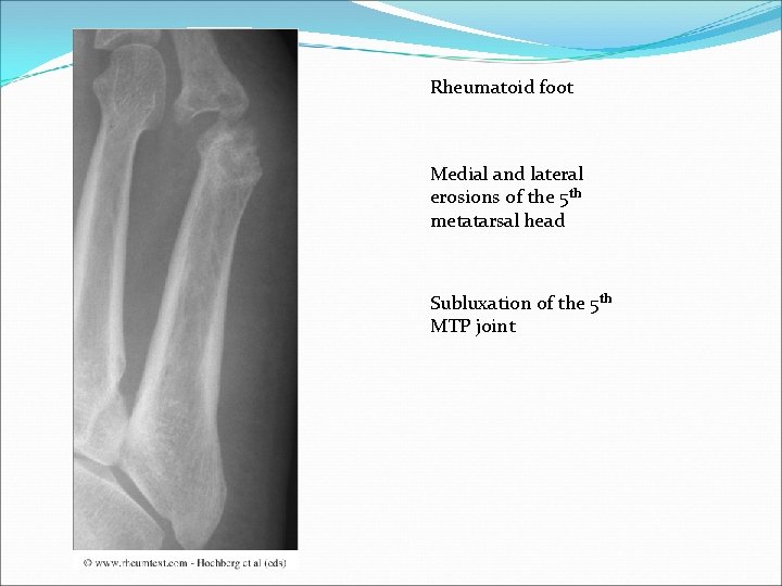 Rheumatoid foot Medial and lateral erosions of the 5 th metatarsal head Subluxation of