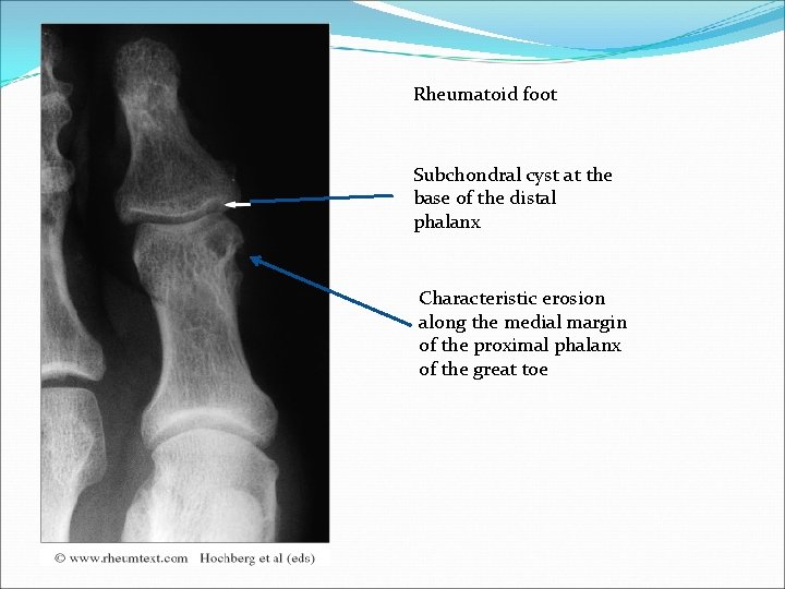 Rheumatoid foot Subchondral cyst at the base of the distal phalanx Characteristic erosion along