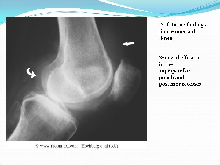 Soft tissue findings in rheumatoid knee Synovial effusion in the suprapatellar pouch and posterior