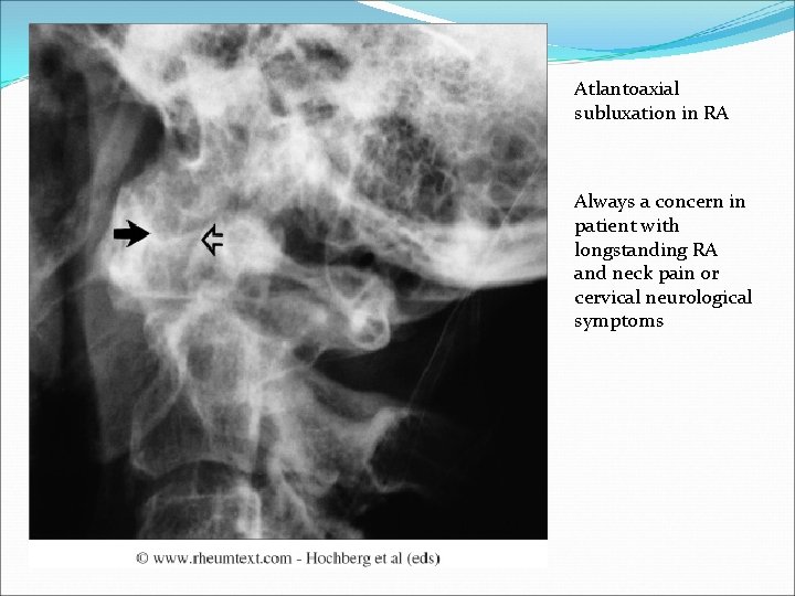 Atlantoaxial subluxation in RA Always a concern in patient with longstanding RA and neck