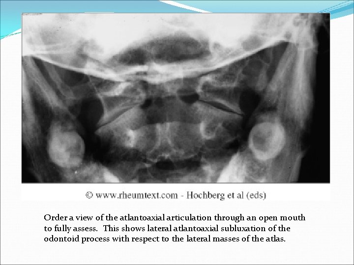 Order a view of the atlantoaxial articulation through an open mouth to fully assess.