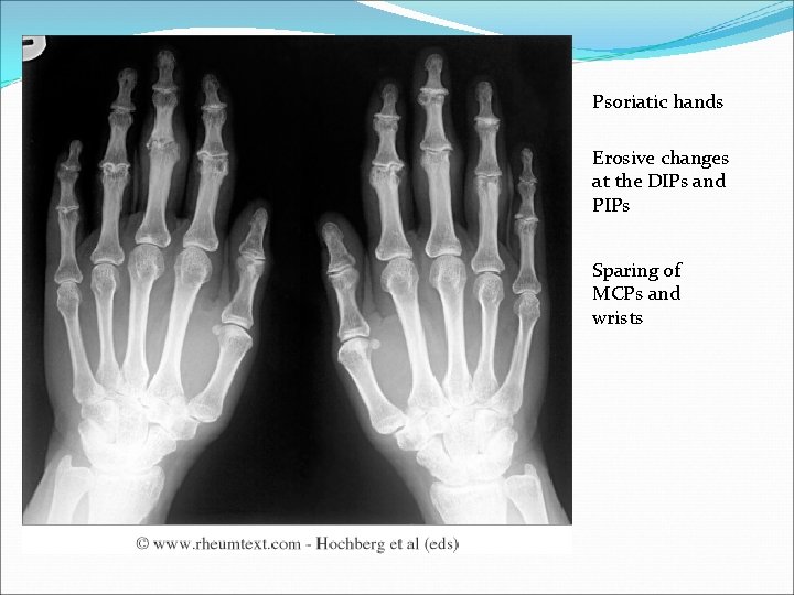 Psoriatic hands Erosive changes at the DIPs and PIPs Sparing of MCPs and wrists