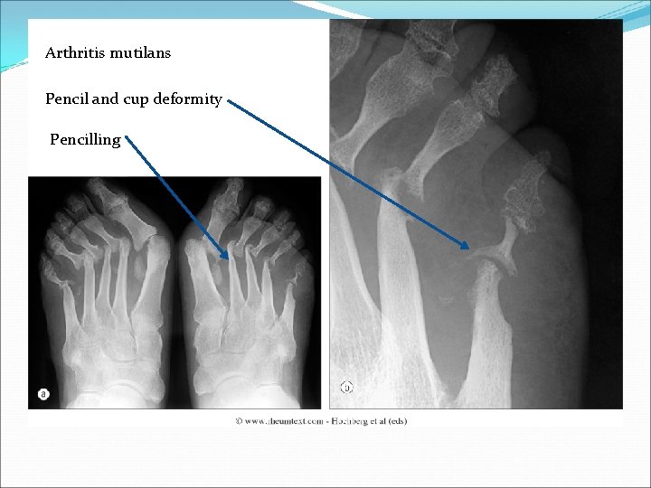 Arthritis mutilans Pencil and cup deformity Pencilling 