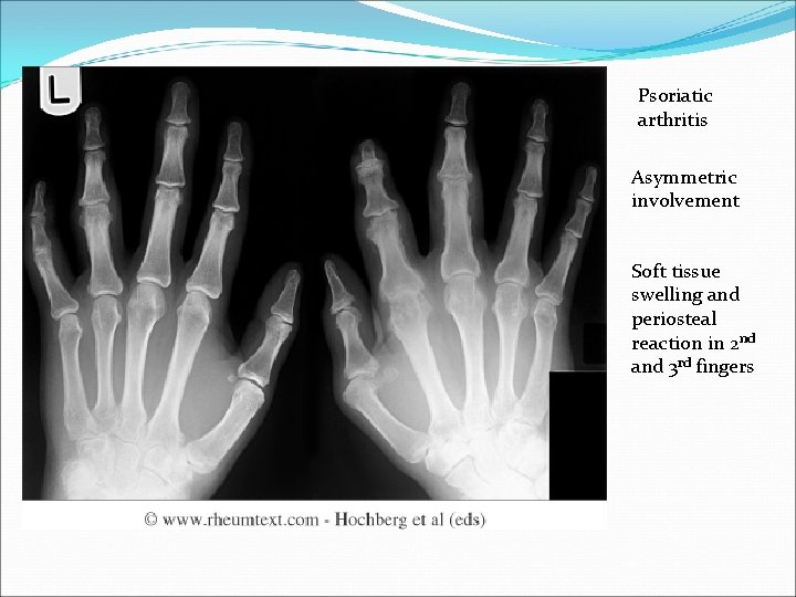 Psoriatic arthritis Asymmetric involvement Soft tissue swelling and periosteal reaction in 2 nd and