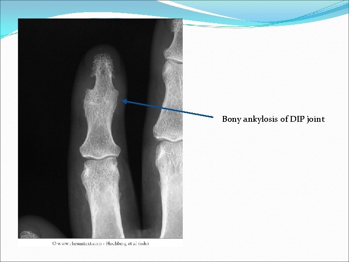 Bony ankylosis of DIP joint 