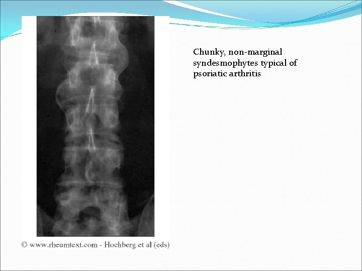 Chunky, non-marginal syndesmophytes typical of psoriatic arthritis 
