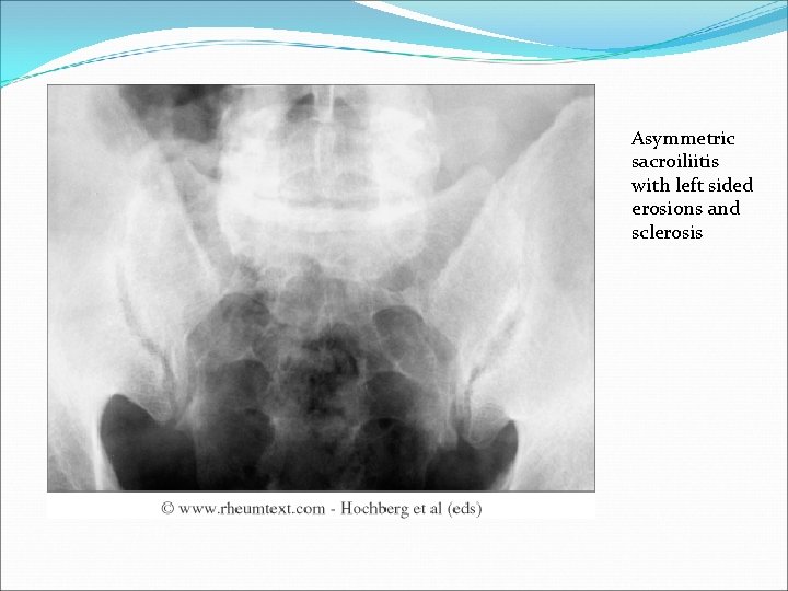 Asymmetric sacroiliitis with left sided erosions and sclerosis 