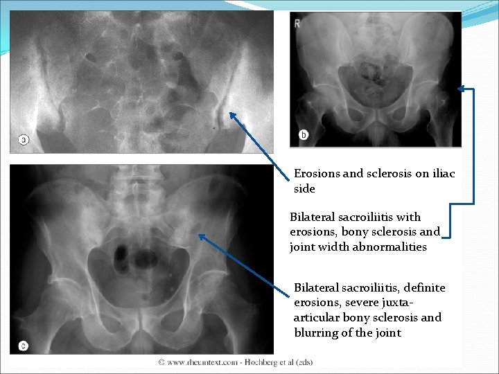 Erosions and sclerosis on iliac side Bilateral sacroiliitis with erosions, bony sclerosis and joint