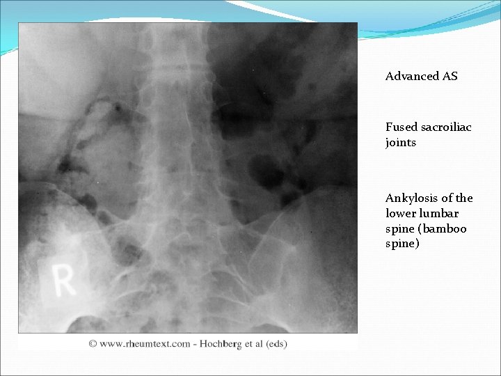 Advanced AS Fused sacroiliac joints Ankylosis of the lower lumbar spine (bamboo spine) 