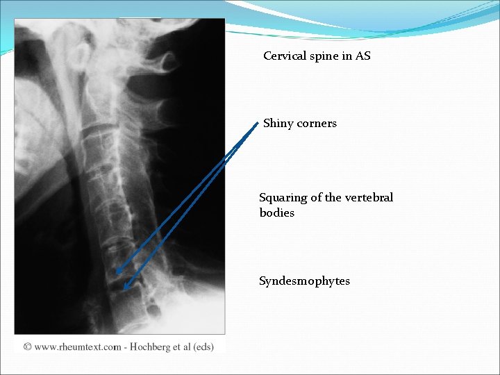 Cervical spine in AS Shiny corners Squaring of the vertebral bodies Syndesmophytes 