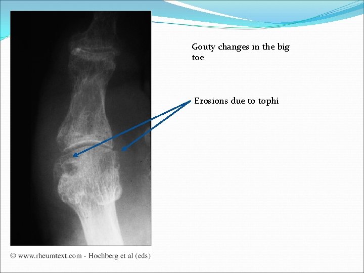 Gouty changes in the big toe Erosions due to tophi 