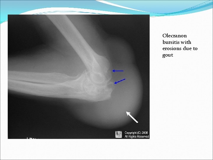 Olecranon bursitis with erosions due to gout 