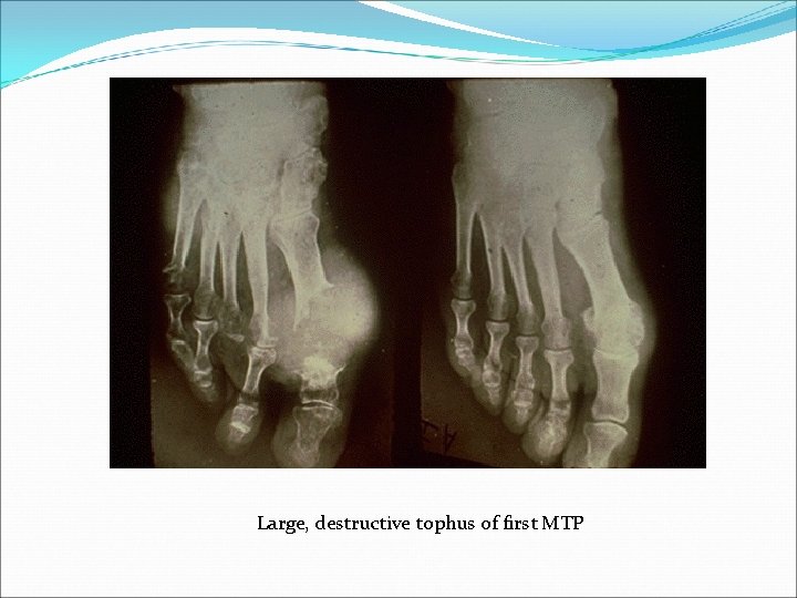 Large, destructive tophus of first MTP 