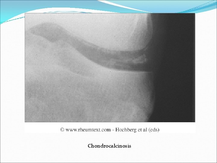 Chondrocalcinosis 