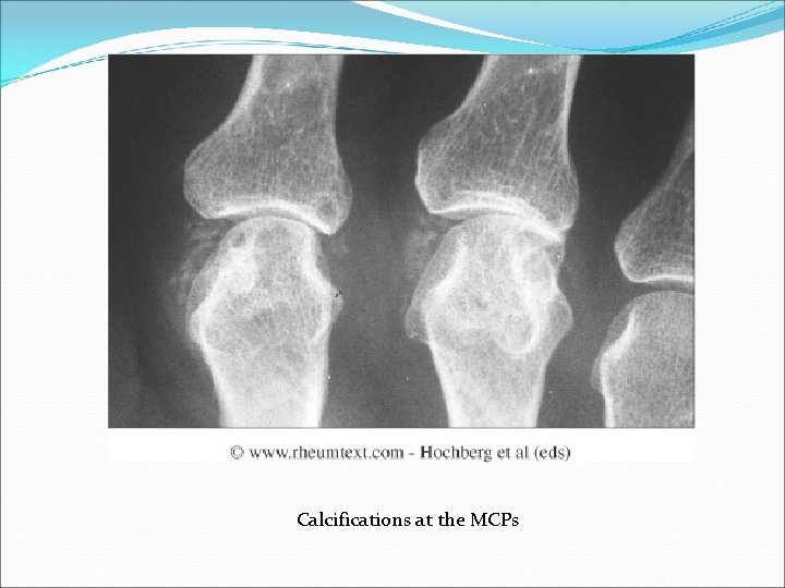Calcifications at the MCPs 