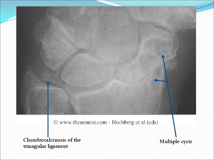 Chondrocalcinosis of the triangular ligament Multiple cysts 