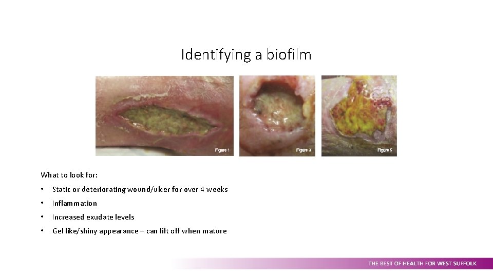 Identifying a biofilm What to look for: • Static or deteriorating wound/ulcer for over