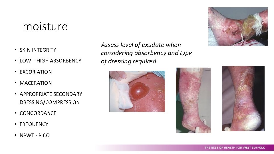 moisture • SKIN INTEGRITY • LOW – HIGH ABSORBENCY • EXCORIATION • MACERATION •