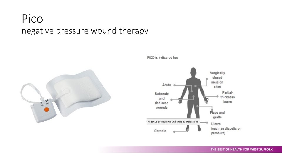 Pico negative pressure wound therapy 