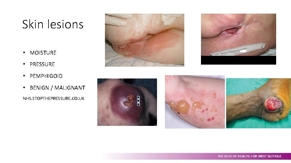 Skin lesions • MOISTURE • PRESSURE • PEMPHIGOID • BENIGN / MALIGNANT NHS. STOPTHEPRESSURE.