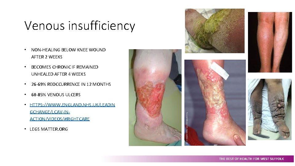 Venous insufficiency • NON-HEALING BELOW KNEE WOUND AFTER 2 WEEKS • BECOMES CHRONIC IF