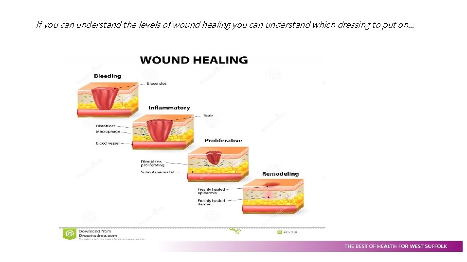 If you can understand the levels of wound healing you can understand which dressing