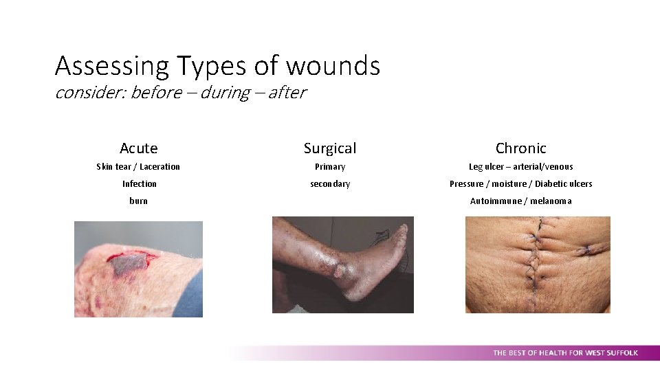 Assessing Types of wounds consider: before – during – after Acute Surgical Chronic Skin
