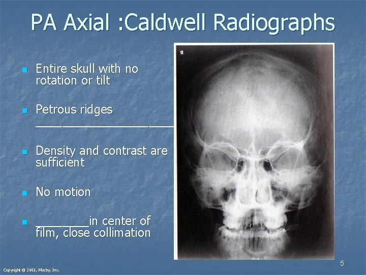 PA Axial : Caldwell Radiographs n Entire skull with no rotation or tilt n