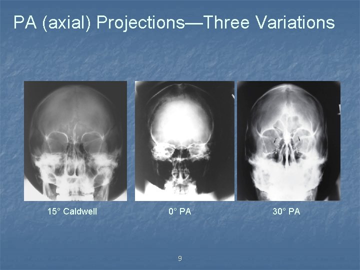 PA (axial) Projections—Three Variations 15° Caldwell 0° PA 9 30° PA 