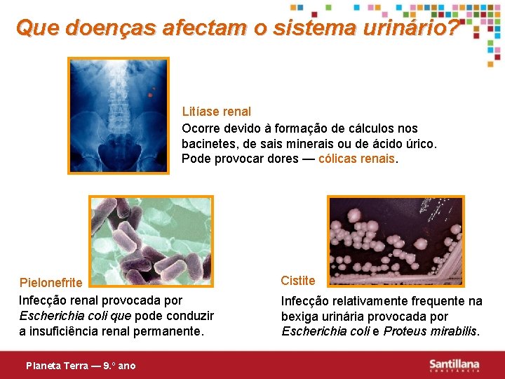 Que doenças afectam o sistema urinário? Litíase renal Ocorre devido à formação de cálculos