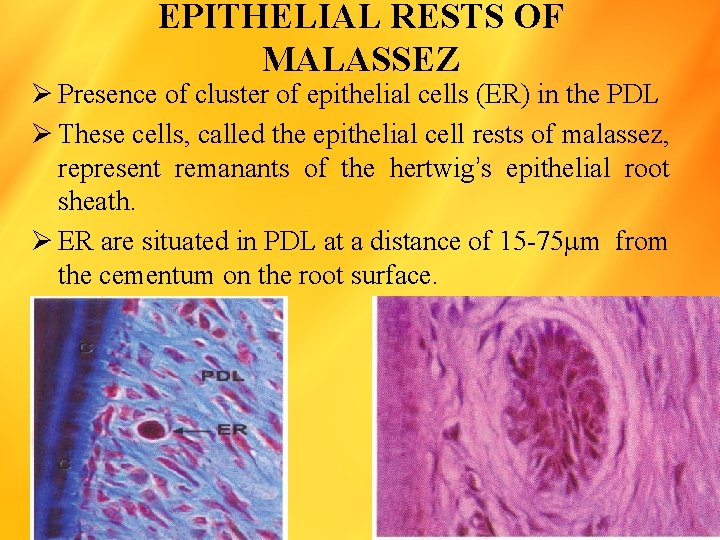 EPITHELIAL RESTS OF MALASSEZ Ø Presence of cluster of epithelial cells (ER) in the