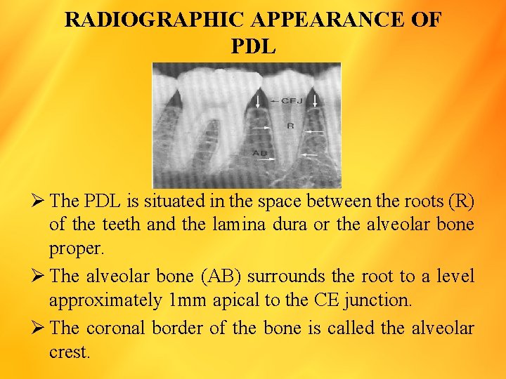 RADIOGRAPHIC APPEARANCE OF PDL Ø The PDL is situated in the space between the