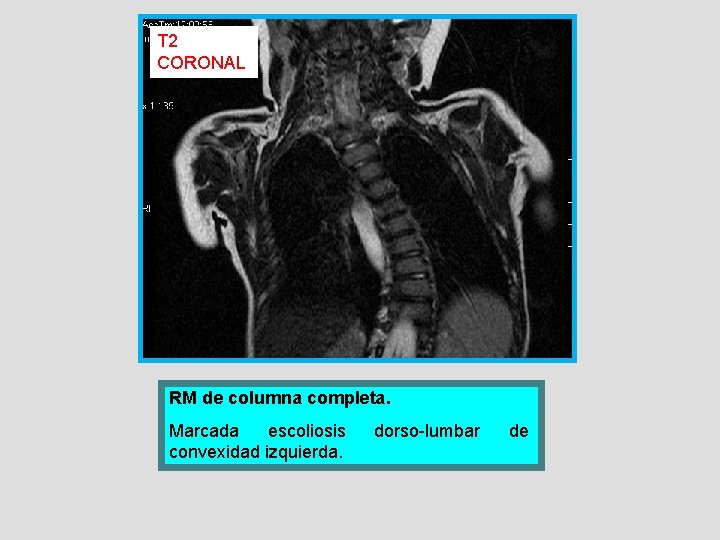 T 2 CORONAL RM de columna completa. Marcada escoliosis convexidad izquierda. dorso-lumbar de 