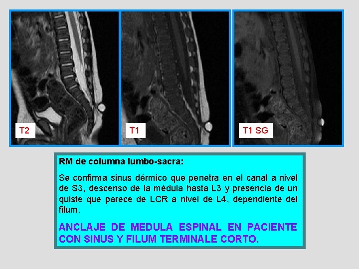 T 2 T 1 SG RM de columna lumbo-sacra: Se confirma sinus dérmico que