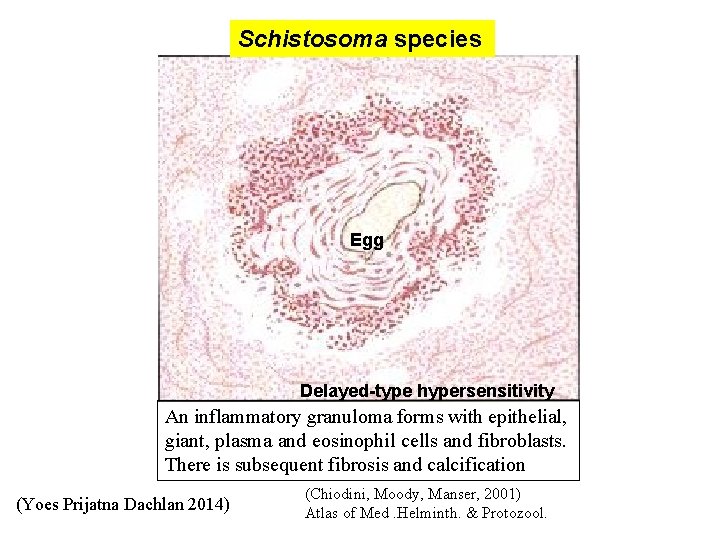 Schistosoma species Egg Delayed-type hypersensitivity An inflammatory granuloma forms with epithelial, giant, plasma and