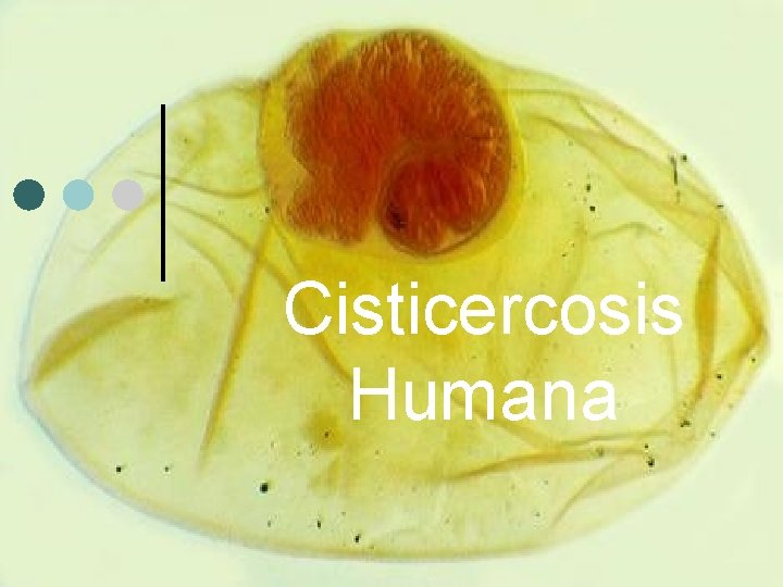 Cisticercosis Humana 
